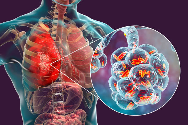 Pertussis: Symptoms, Causes, and Treatment